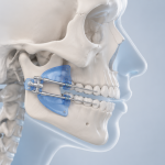 Criança a utilizar aparelho removível de Ortopedia Funcional dos Maxilares durante consulta de Medicina Dentária